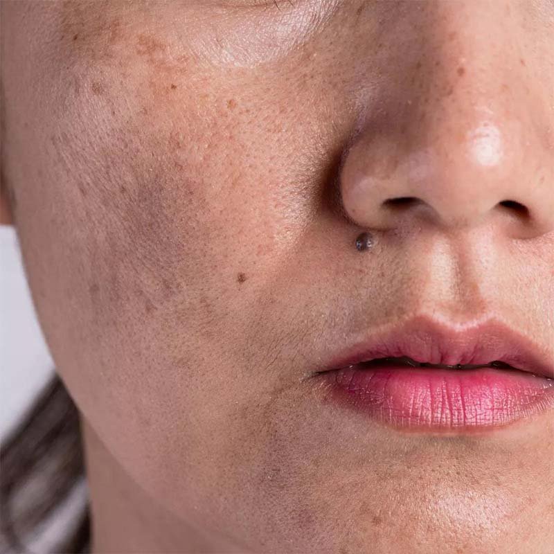 Treatment hyper pigmentation